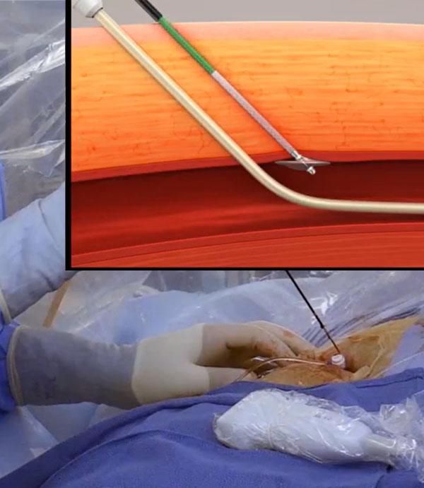 Haemonetics Vascular Closure VASCADE MVP